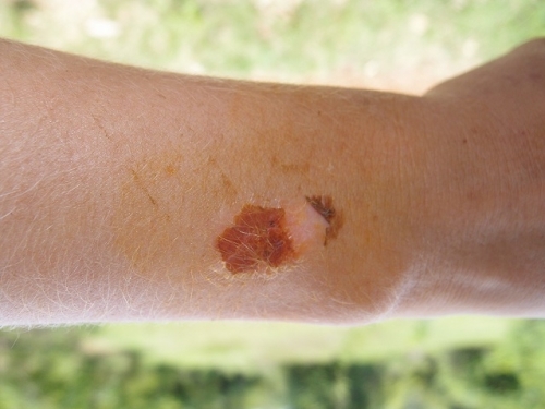 лечение куркумой, лечение ожога свежим соком из корня куркумы | Natural analgetic remedy to cure external wounds, treatment of burn with turmeric root fresh juice
